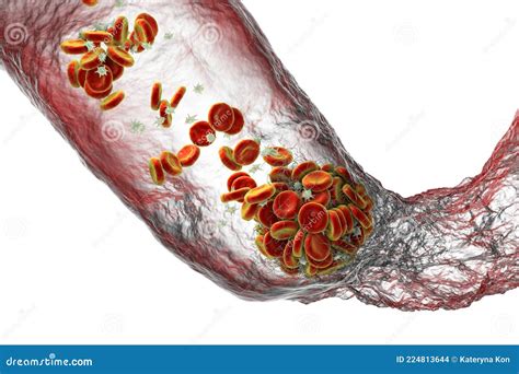 Blood Clot Made Of Red Blood Cells Platelets And Fibrin Protein