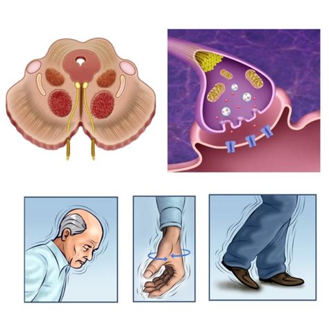 Parkinson Cos è Cause Morbo di Parkinson e Primi Sintomi