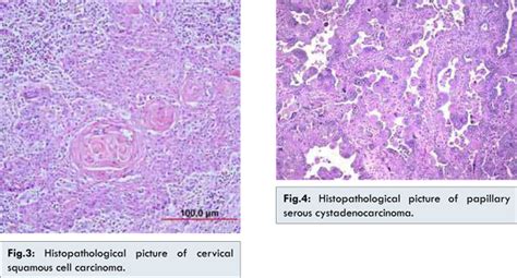 A Rare Case Of Carcinoma Of Ovary With Carcinoma Of Cervix