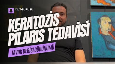 Keratozis Pilaris Tavuk Derisi G R N M Tedavisi Youtube