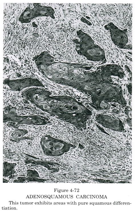 Pathology Outlines Adenosquamous Carcinoma