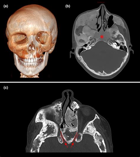 Polyostotic Fibrous Dysplasia Histology