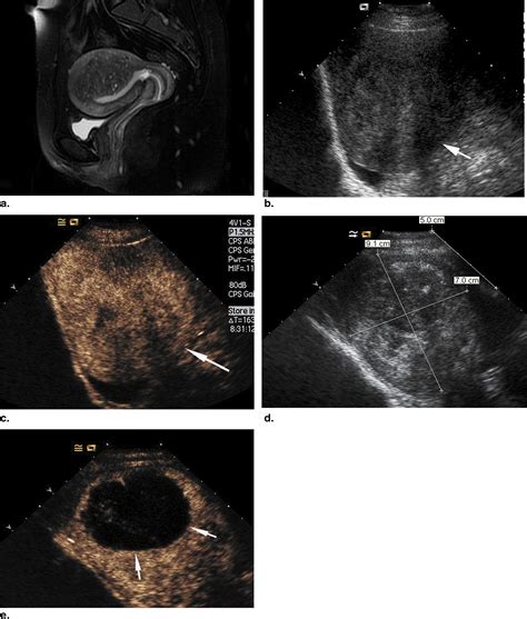 Safety And Efficacy Of High Intensity Focused Ultrasound Ablation