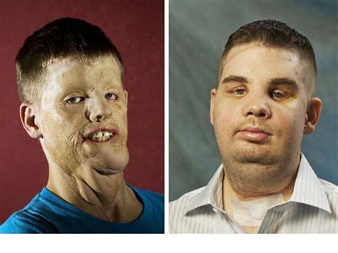 Face transplant surgery: How are patients now? - CBS News