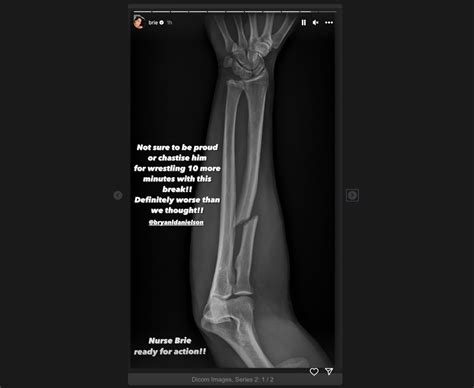 Wrestlezone On Twitter An Update On Bryan Danielson S Arm From