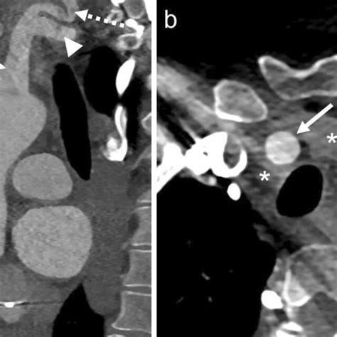 Sagittal Multiplanar Reformat Mpr Computed Tomography Angiography