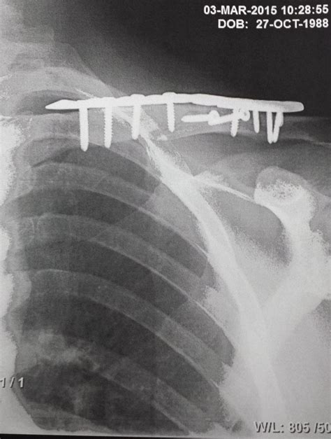 Broken clavicle surgery - plate and screws - What would you do?- Mtbr.com