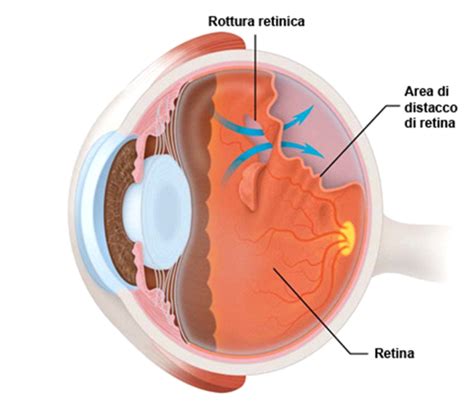 Distacco Di Retina C M O