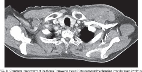 Figure 1 from NK/T cell lymphoma associated with peripheral ...