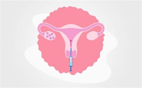 Things To Know Before And After Your Embryo Transfer By Kiran