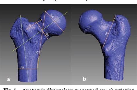 Figure 1 From Sex Assessment From The Proximal Femur In The Spanish Population Based On Three