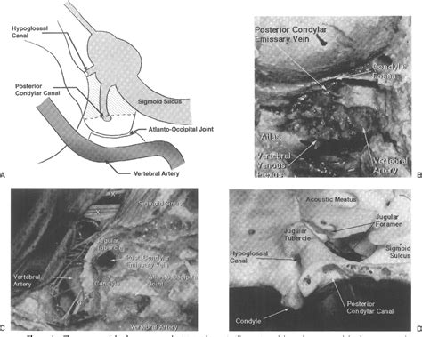 Figure 4 From Microsurgical Anatomy For Lateral Approaches To The