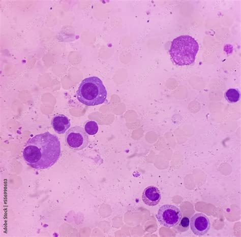 Bone Marrow Study Plasma Cell Dyscrasia Or Multiple Myeloma Present