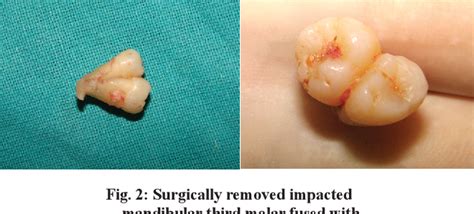 Concrescence Of Impacted Mandibular Third Molar With A Fourth Molar