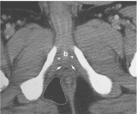 Anat Male Pelvis Radiology Flashcards Quizlet