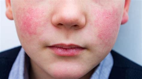 Common kid skin rashes and sensitivities and treatments - Today's Parent