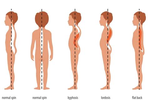 What Is Scheuermanns Disease Scheuermann Disease Symptoms Morbus Causes Therapy Options Lumbar