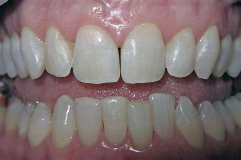 Patient with Gap in Teeth - Mark T. Albers, D.D.S.