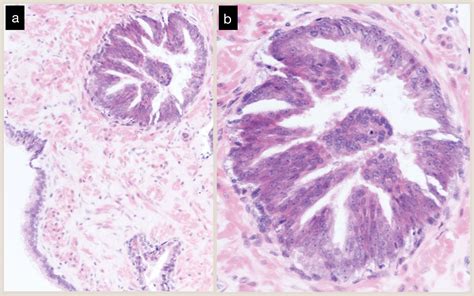 An Update On Atypical Large Glandular Proliferations Of The Prostate