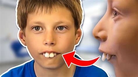 Boy Bullied For Buck Teeth Visits An ORTHODONTIST Massive