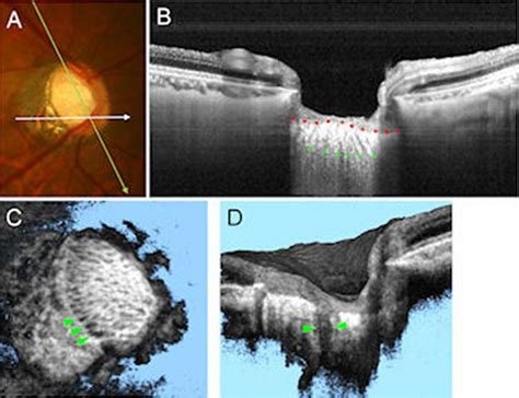 Figure Swept Source Optical Coherence Tomography Ss Oct For