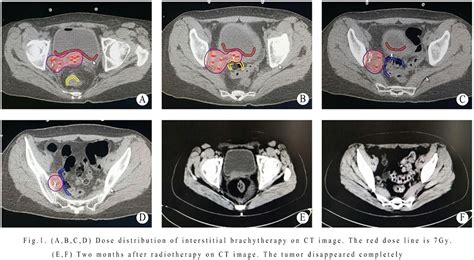 Metal Tube Combined With Ultrasound Guided Accurate Interstitial Brachytherapy For Postoperative