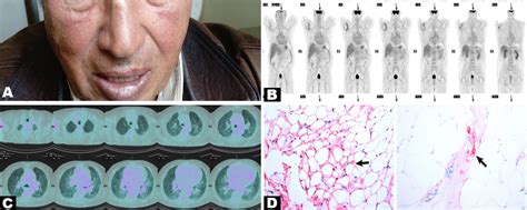 Incidental Multiple Adenopathies And The Diagnosis Of Systemic