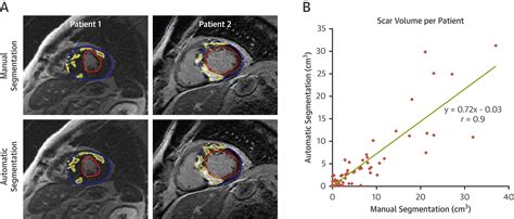 Automated Cardiac Mr Scar Quantification In Hypertrophic Cardiomyopathy