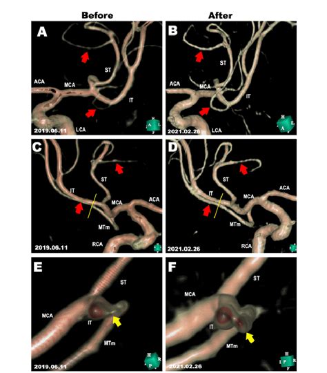 Morphological evaluations of the MRA before and after cytokineinduced... | Download Scientific ...