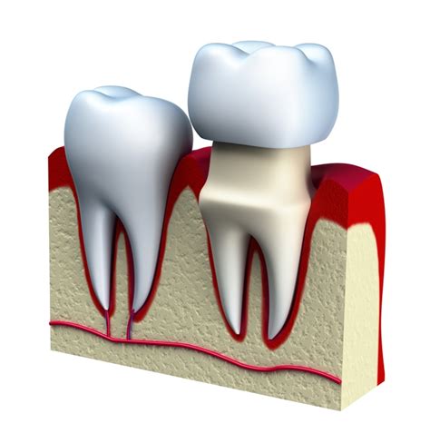 Cap Dental Dental Caps And Crowns Dr Stone Dds