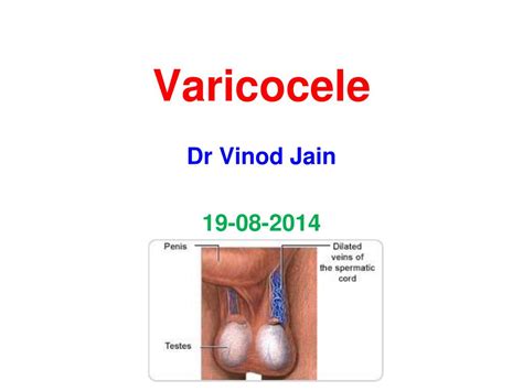 Ppt Varicocele Powerpoint Presentation Free Download Id 6413777