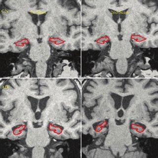 Hippocampal atrophy detected in AD patients. Two MRI scans 1 year apart ...