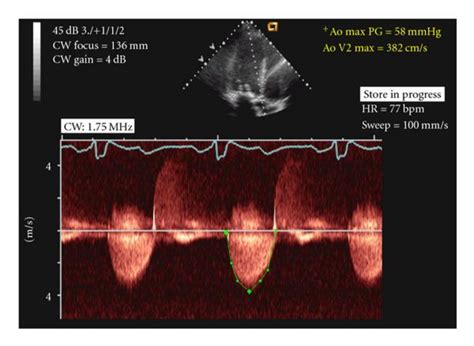 Echocardiogram Aortic Stenosis