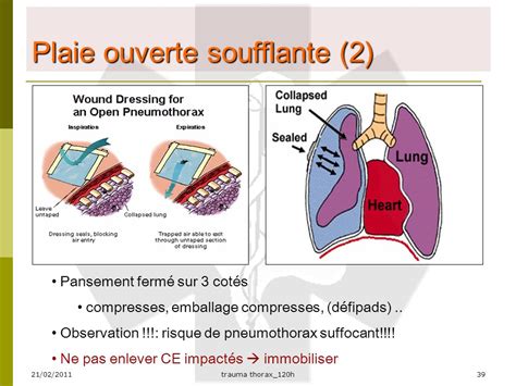 Traumatismes thoraciques ppt video online télécharger