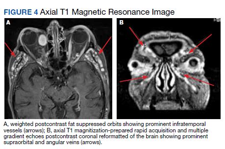 Orbital Varix Masquerading As An Intraorbital Lymphoma Federal