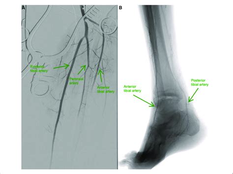 A And B A Baseline Angiography Shows Total Occlusion From The