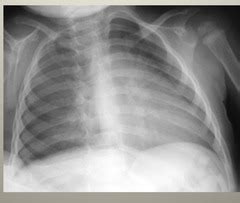 Radiology Quiz 4 Pneumonia And Cardiac Quizlet