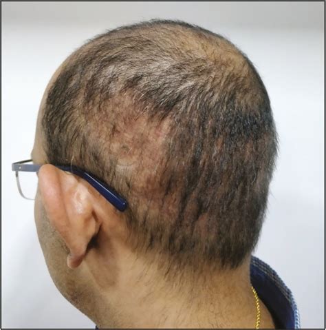 What Is Hair Transplant Overharvesting Wimpole Clinic