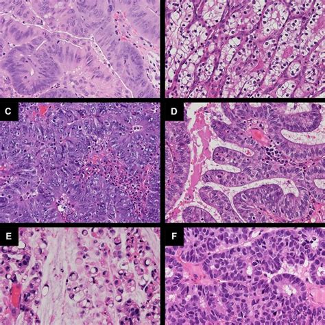 Histomorphological Appearance Of Different Types Of Sinonasal