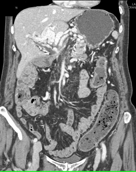 Angiodysplasia Of The Right Colon And Cavernous Transformation Of The