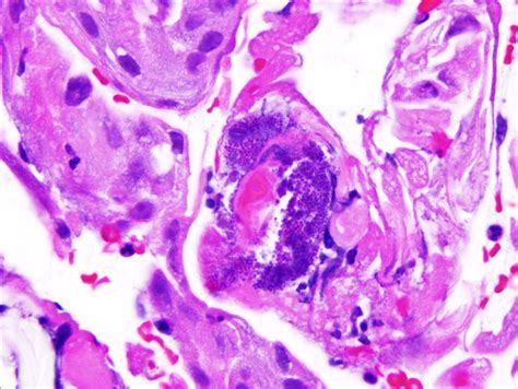 Sarcina Organisms In The Gastrointestinal Tract A Clinicopathologic