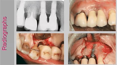 Peri Implantitis Stages Ph