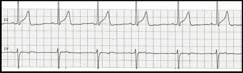 Practice Ekg Rhythm Strips 153