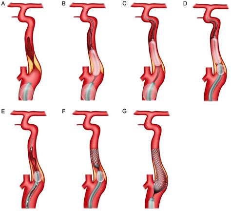 Relay Balloon Technique For Recanalization Of Acute Symptomatic