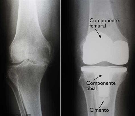 Artroplastia Total De Joelho E Parcial Indica Es Dr M Rcio Silveira