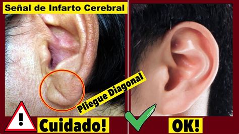 Si Tienes Pliegue En La Oreja Así Puede Ser Inicio De Derrame Cerebralapoplejía Youtube