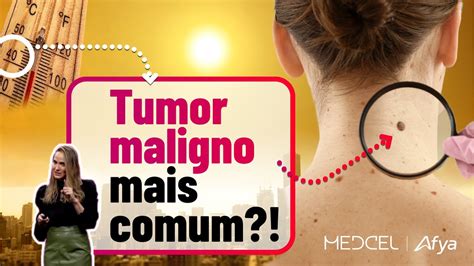 O Que Você Precisa Saber Sobre Carcinoma Basocelular Da Pele Youtube