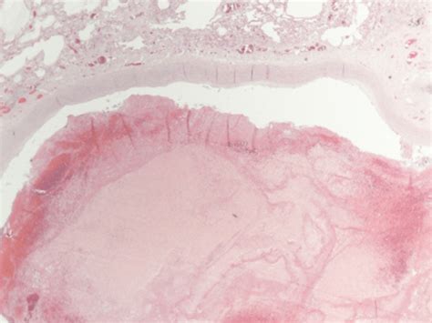 Pulmonary Thromboembolus Download Scientific Diagram