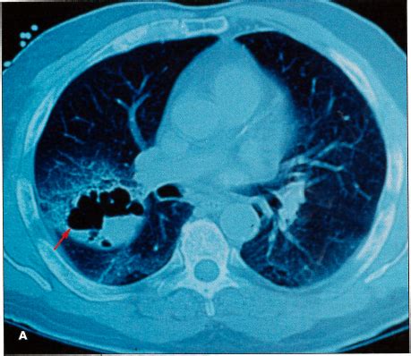 Cavitary Lung Cancer With Metastases | Consultant360