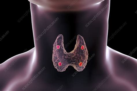 Parathyroid Glands Illustration Stock Image F Science